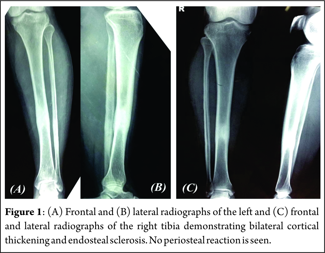 Frontal and (B) lateral radiographs of the left and (C) frontal and lateral radiographs of the right tibia demonstrating bilateral cortical thickening and endosteal sclerosis. No periosteal reaction is seen